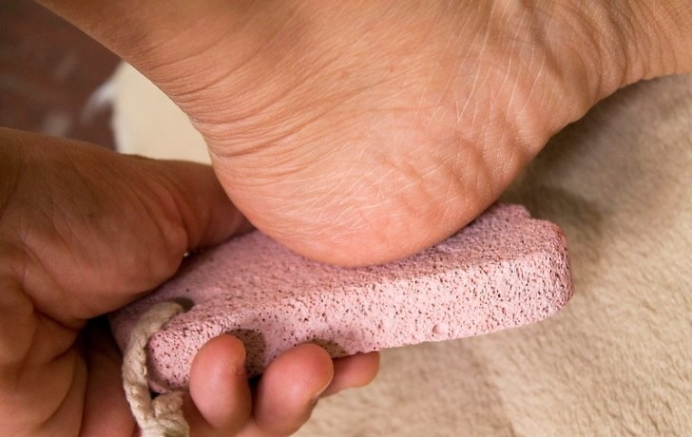 如何摆脱足部老茧(胼胝)