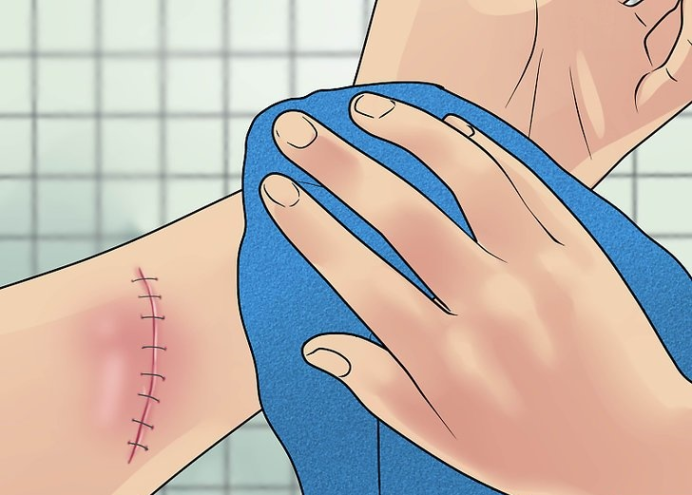 安全地清洗手术伤口