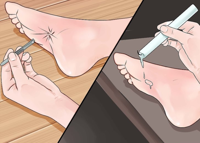 如何治疗海胆刺伤