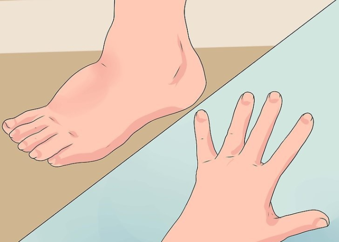 外周性水肿的特征是脚踝,双脚,手臂和双手浮肿.