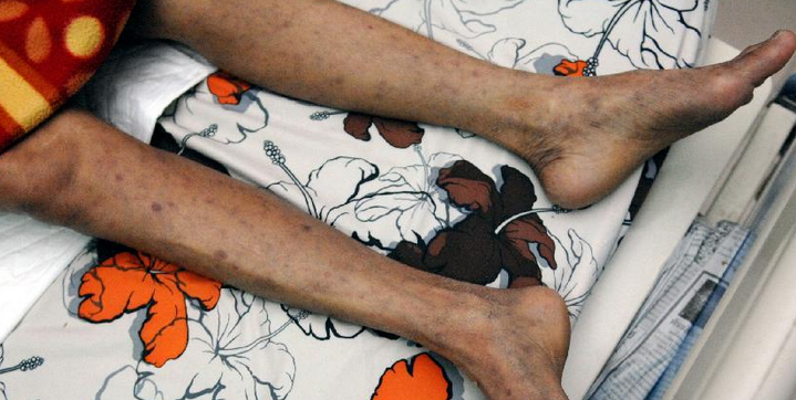 艾滋病图片 爱滋病发病过程分几个阶段